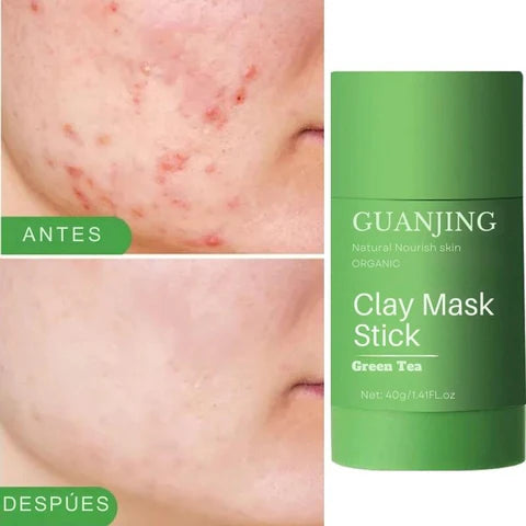 Mascarilla Anti Acné - Te Verde